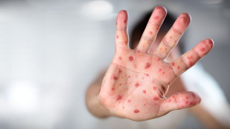 _99311080_measles_get